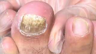 Paronychia Treatment of Fungal Nail Infections [upl. by Nydroj]