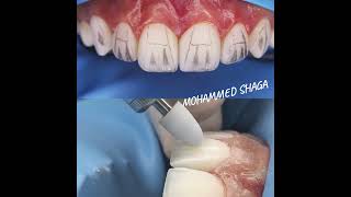 Finishing amp Polishing Composite Veneer Step by StepHow to create V shape grove anatomy and texture [upl. by Fitzsimmons]