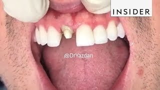 How Dentists Create Tooth Veneers And Crowns [upl. by Coonan908]