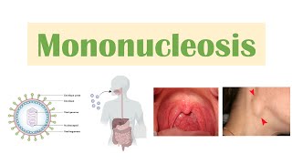 Infectious Mononucleosis Mono  EpsteinBarr Virus Transmission Symptoms Diagnosis Treatment [upl. by Ellehcirt]