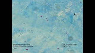 Acidfast bacilli Sputum Sample Mycobacterium tuberculosis [upl. by Rhiana]