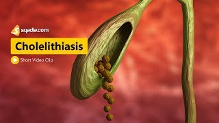 How to Pronounce Choledocholithiasis [upl. by Nyrrad]