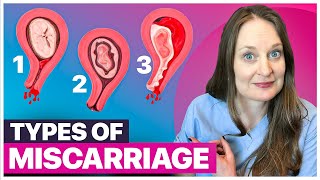 10 Kinds of Miscarriages Understanding the Difference and Why It Matters [upl. by Eednarb]