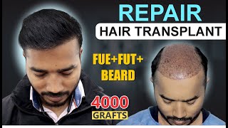 REPAIR Hair Transplant Results at Medispa Hair Transplant India  Best Cost  Best Result [upl. by Acirretal]