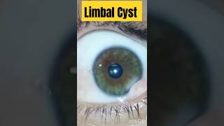 Limbal Cyst  Optometry With Shahid [upl. by Colon]