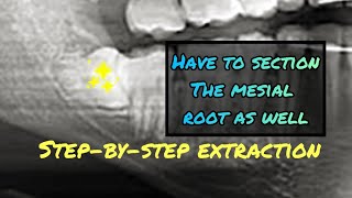 When the Mesial Root is Stuck Step by Step Wisdom Tooth Extraction Video with Instruments Listed [upl. by Grassi]