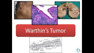 Warthins tumor [upl. by Dorri]