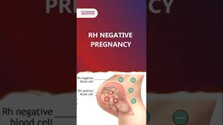 RH Negative Pregnancy  Dr Debashish Sarkar drdebashishsarkar sarkarhospital rhnegativepregnancy [upl. by Ane]