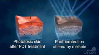 Clinuvel improving quality of life  Photodynamic Therapy PDT [upl. by Bittencourt]