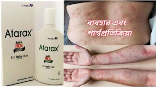 Atarax AntiItch Lotion Benefits In Bengali Atarax Lotion এলার্জির সমস্যায় লাগান ৷৷ Medicine In [upl. by Anaizit]