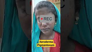 Xeroderma Pigmentosum  DermaCase  Basal cell amp Squamous cell Carcinoma  Sun induced Pigmentation [upl. by Cherida]