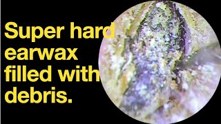 Super hard earwax filled with debris ear wax removal  ear cleaning  ASMR  relaxation  relax [upl. by Eisak]