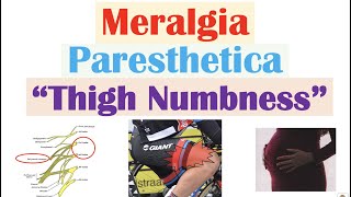 Meralgia Paresthetica “Numbness of the Thigh”  Causes Symptoms Diagnosis Treatment [upl. by Halian]