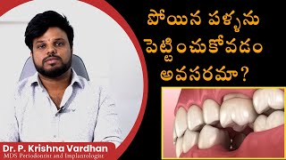 పోయిన పళ్ళను పెట్టించుకోవడం అవసరమా Dental Implants  Dr P Krishna Vardhan  Sree Balaji Dentals [upl. by Ahtenek]