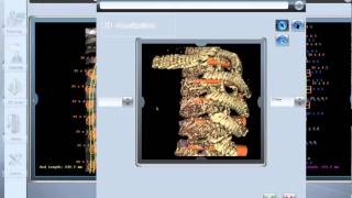 Mazor Robotics CT based 3D planning for spine surgery [upl. by Patsis]