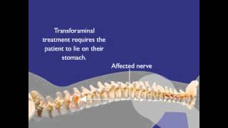 Epidural steroid injection transforaminal approachmov [upl. by Teragram]