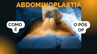 COMO É o pós operatório da abdominoplastia [upl. by Mahala]