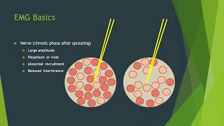 Neuropathy vs myopathy on EMG [upl. by Dymoke228]