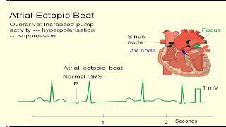 EKG itu Gampang Sesi 3Aritmia Dasar [upl. by Neenad]