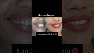 Sorriso gengival beauty skincare botox lábios estetica belezaquetransforma [upl. by Christenson214]