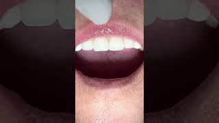 Cementing anterior zirconia crownsdentist teeth tooth dentista [upl. by Clein]