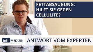 Hilft eine Fettabsaugung gegen Cellulite  Expertenantwort von Dr Kiermeir [upl. by Ashmead88]