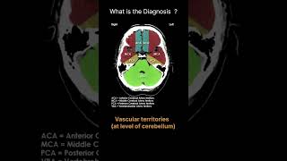 Vascular territories  at level of cerebellum CT Brain Anatomy Quiz 34 radiologychannel007 [upl. by Irafat]