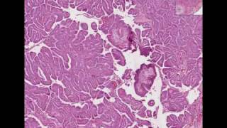 Histopathology Thyroid Papillary carcinoma [upl. by Lirbij851]