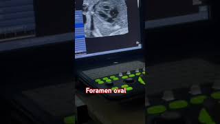 Tabique interventricular y foramen oval [upl. by Fe]