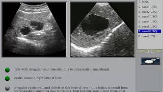 Liver Ultrasound Liver cysts in Arabic أكياس الكبد [upl. by Yeliw733]