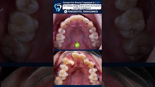 Braces Treatment Timelapse dentist facts toothdental dentalhygiene braces [upl. by Yerffoeg]