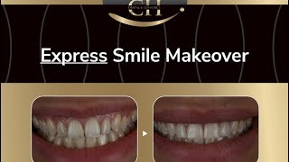 Our Treatment PackagesExpress Smile Makeover 😁 [upl. by Hazmah]