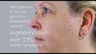 IPL gezichtsbehandeling pigmentvlekken [upl. by Harriett]