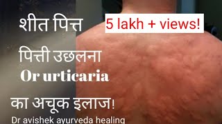 URTICARIA HINDI PITTI KA ILAJ SHEETPITTA AYURVEDIC CUREDravishekayurveda [upl. by Lleuqram]