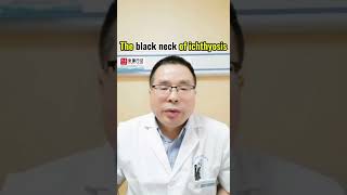 How to treat black neck of ichthyosis ichthyosis ichthyosisvulgaris dryskin dermatologist [upl. by Ocramed303]