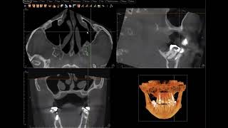 Completely full maxillary sinus cleared [upl. by Lanny]