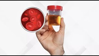 Isolated Hematuria  Definition Causes Evaluation and Management [upl. by Hein861]