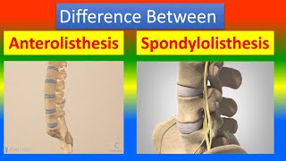 Difference Between Anterolisthesis and Spondylolisthesis [upl. by Ahl224]