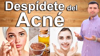 COMO CURAR EL ACNE  Como Eliminar el Acne y Sus Manchas Naturalmente y Para Siempre [upl. by Daph]