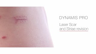 Laser Scar and Striae Revision [upl. by Navillus]