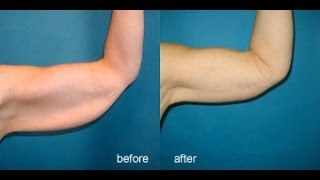 Exercises For Flabby Arms شد ترهل الذراعين [upl. by Olia]