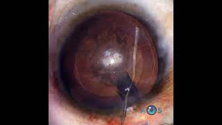 Anterior Subcapsular Cataract in Young Adult [upl. by Aratihc]