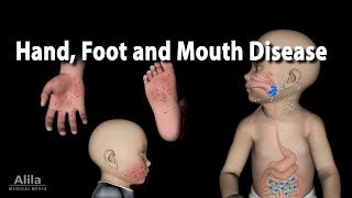 Hand Foot and Mouth Disease Animation [upl. by Jayne]