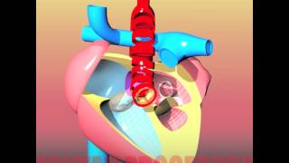 Congenital heart defects III HLHS  Hypoplastic Left Heart Syndrome [upl. by Dyl]