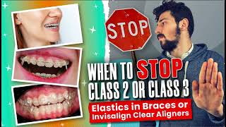 When to STOP Invisalign or Braces Class 2 or Class 3 Elastics [upl. by Leuqcar]