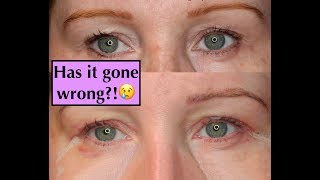 Blepharoplasty Experience UK Eyelid SurgeryHooded Eyes  1 WkStitches Removed [upl. by Sobel]