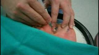 Retrobulbar injection for cataract surgery anesthesia [upl. by Killen579]