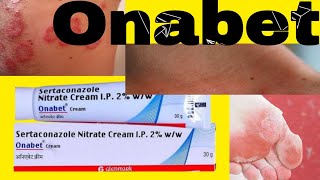 Onabet Cream  Sertaconazole Nitrate Cream Uses in Hindi [upl. by Sukramed]