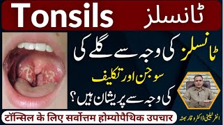 Tonsils گلے کی سوجن اور تکلیف टॉन्सिल Homeopathic Treatmennt By Dr Waqar Bhutta In Urdu  Hindi [upl. by Welcy]