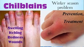 Chilblains  chilblains treatment [upl. by Robina]